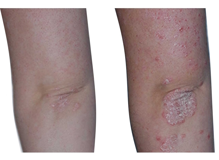 Psoriasis Eczema Vitiligo treatment lamp