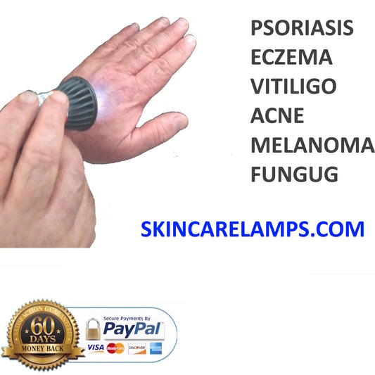 Psoriasis Eczema treatment lamp USB